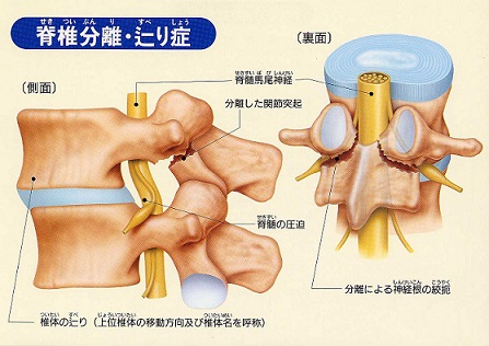 分離症.jpg